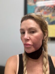 Miserable’ Brandi Glanville blames Bravo for severe facial swelling: ‘Stress will kill you’